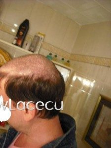 Alopecia androgenética: ¿qué es y cómo solucionarlo?