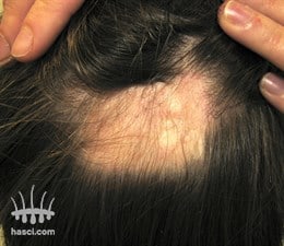 Alopecia y caída de cabellos causados por estrés