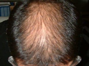Pérdida de cabello: frontera entre la genética y la estacionalidad