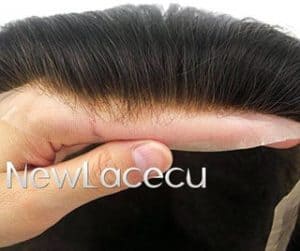 Alopecia en niños