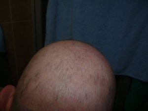 alopecia areata