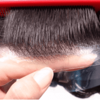 protesis frontal