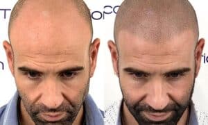 Tricopigmentación capilar: Qué es y por qué a veces no conviene