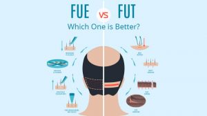 Trasplante de cabello FUE vs FUT Qué cirugía de trasplante es la mejor