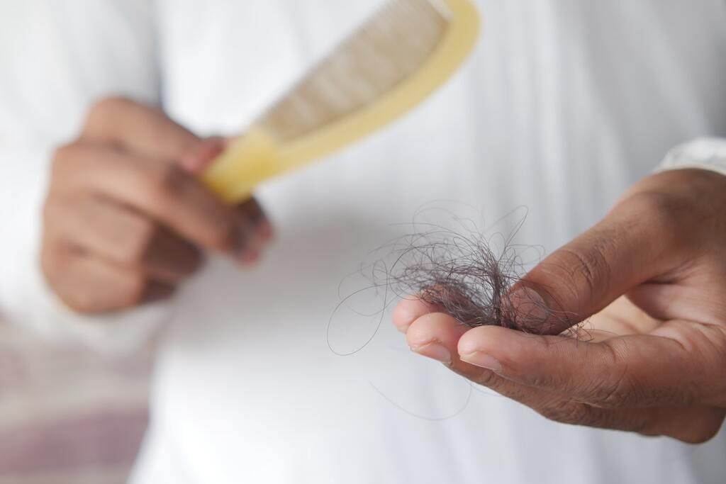 Alopecia androgenética en hombres y mujeres qué es causas tratamientos