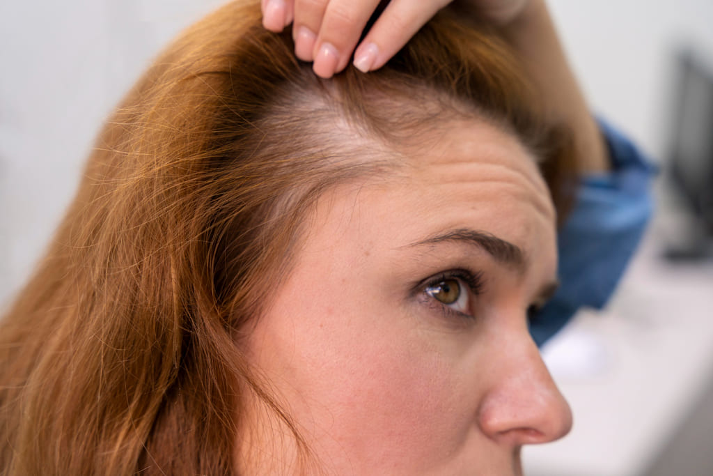 causas de los tipos de alopecia en mujeres