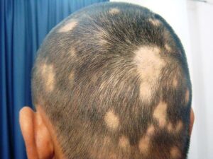 Alopecia Areata: Un Misterio por Revelar